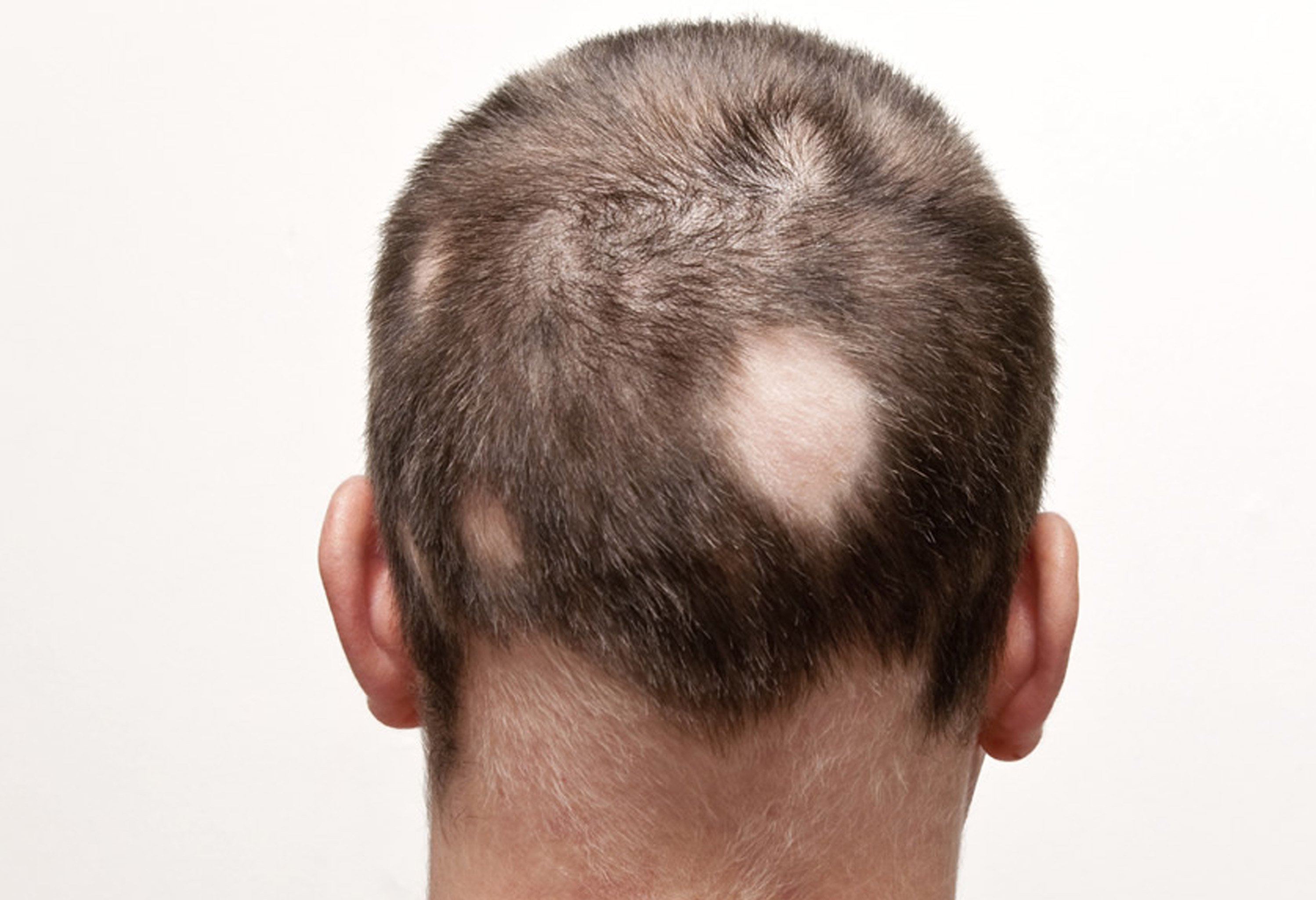 Homeopathic treatment for Alopecia Areata (Autoimmune hair loss in patches)